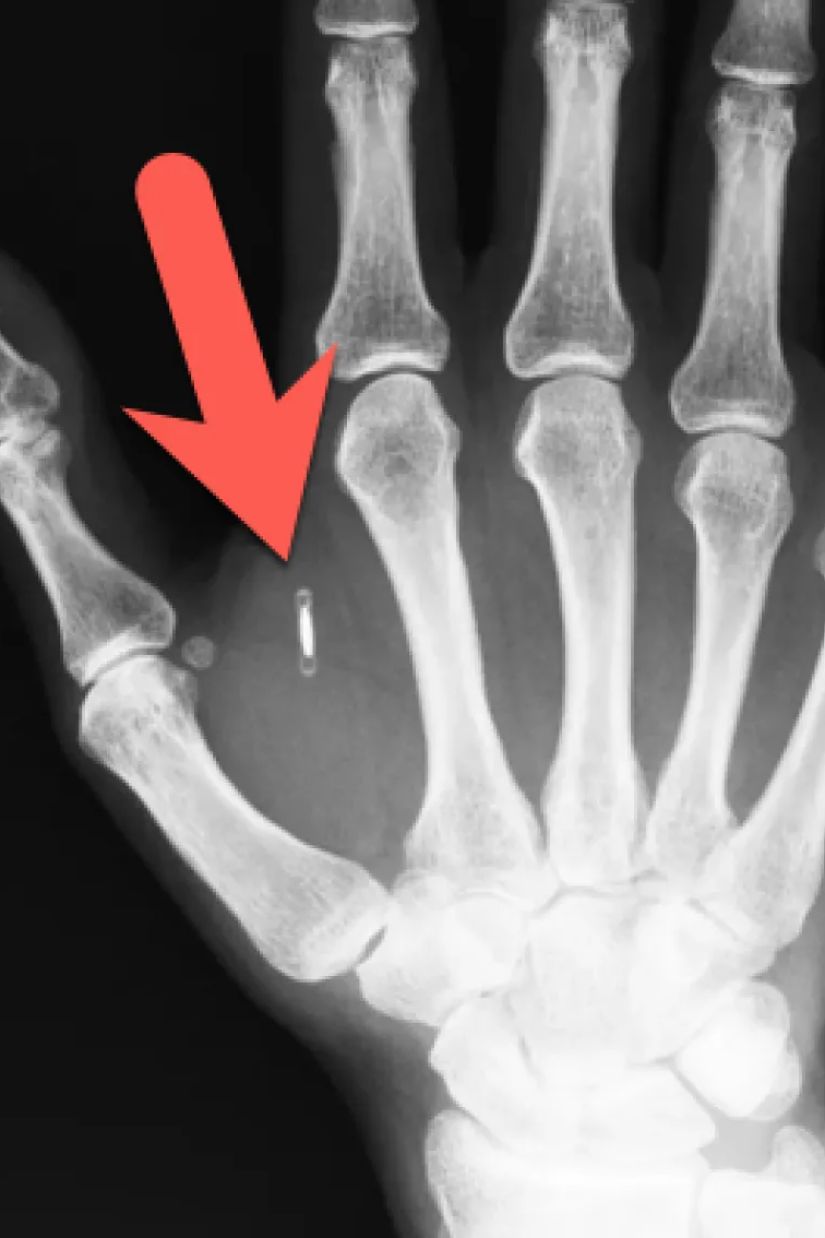 მიკროჩიპები
ადამიანისთვის