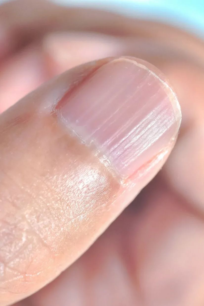 რაზე მეტყველებს ფრჩხილის
პათოლოგიები?